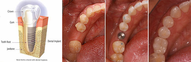 Before and After, Missing Tooth, Implant, Implant Supported Crown